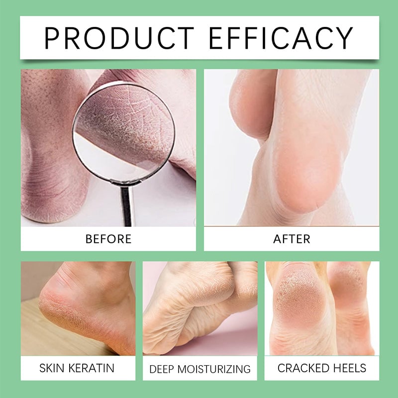 Feet Callus Remover
