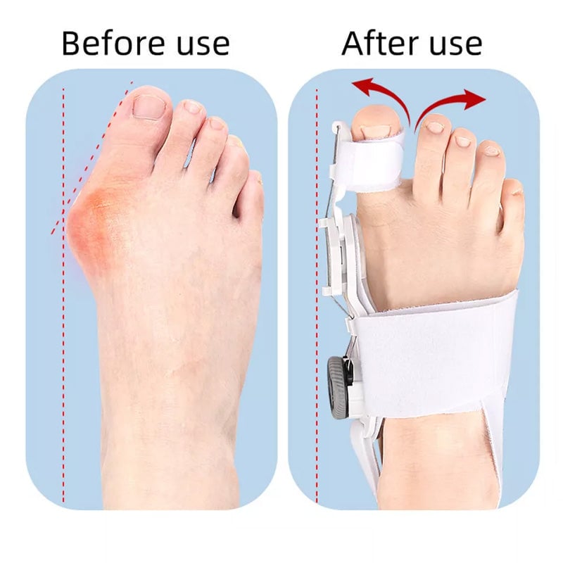 Upgraded Bunion Corrector